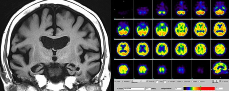 MRI、SPECTの写真